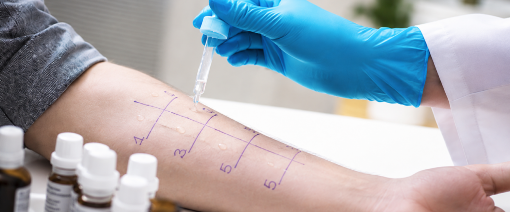 skin prick testing